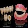 راهنمای کامل انواع پروتزهای دندانی ثابت و متحرک؛ کدام گزینه بهتر است؟