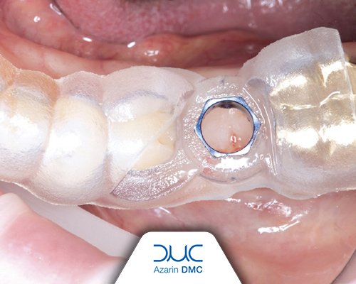  ساخت جراحی گاید با پرینتر 3D و میلینگ