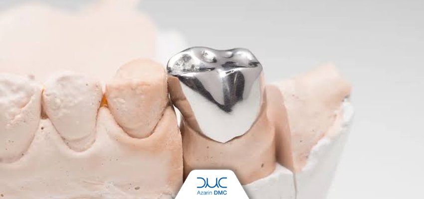 فیت (Fit) در ترمیم‌های دندانی چیست و چگونه ارزیابی می‌شود؟