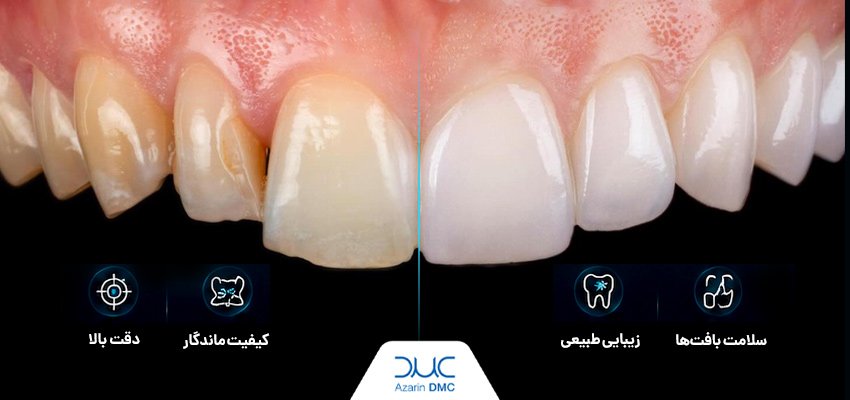 اهمیت مارجین لاین در دندانسازی؛ بررسی انواع و نکات مهم